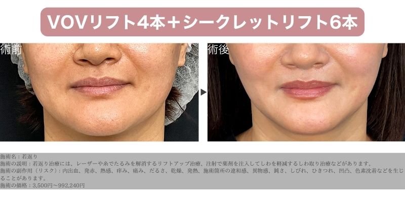 若返り治療：40代女性